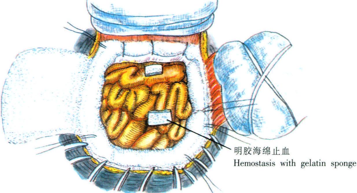 急性或亞急性硬腦膜下血腫和腦內(nèi)血腫清除術(shù)
